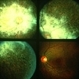 Choroiditis Choroiditis